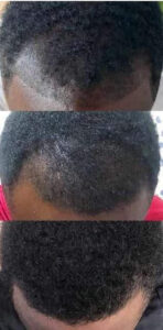 Retrouvez votre chevelure et votre barbe naturellement-sans effets secondaires